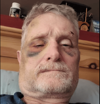 Nelson resident says he was attacked by police